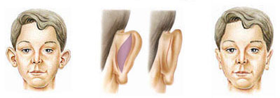 age-Otoplasty